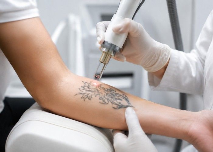Does Tattoo Removal Improve Skin Appearance Over Time?