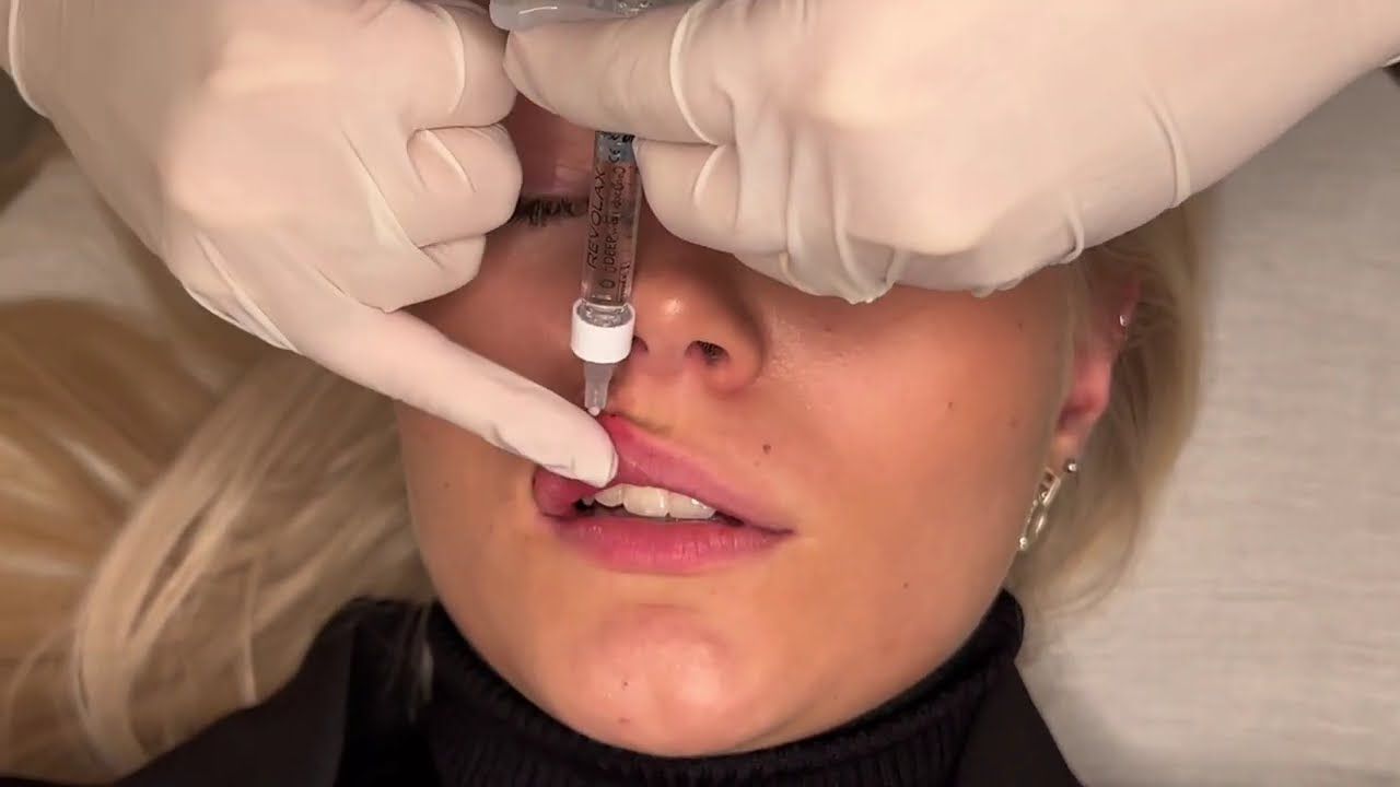 What Makes Lip Filler a Popular Choice for Fuller Lips?