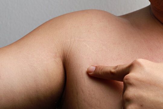 What Makes Stretch Marks Removal a Modern Solution?