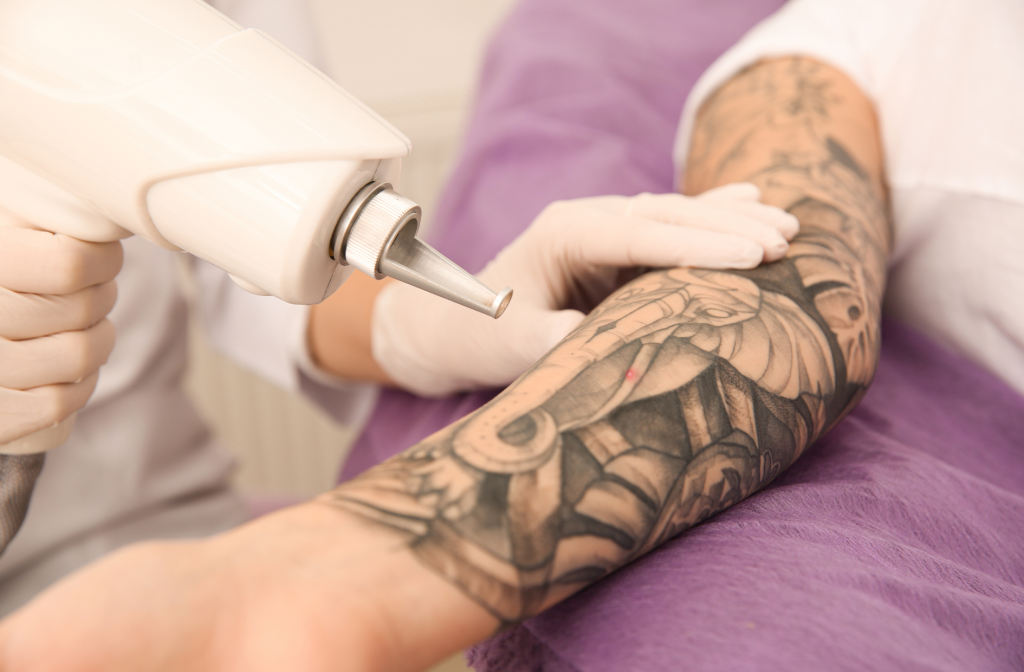 Can Tattoo Removal Help Fade Tattoos With Detailed Designs?