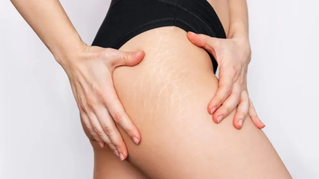 Does Stretch Marks Removal Reduce Visible Mark Lines Today?