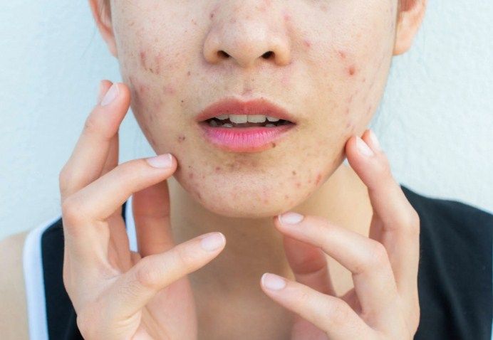 How Can Acne Treatment Help Reduce Facial Skin Imperfections?