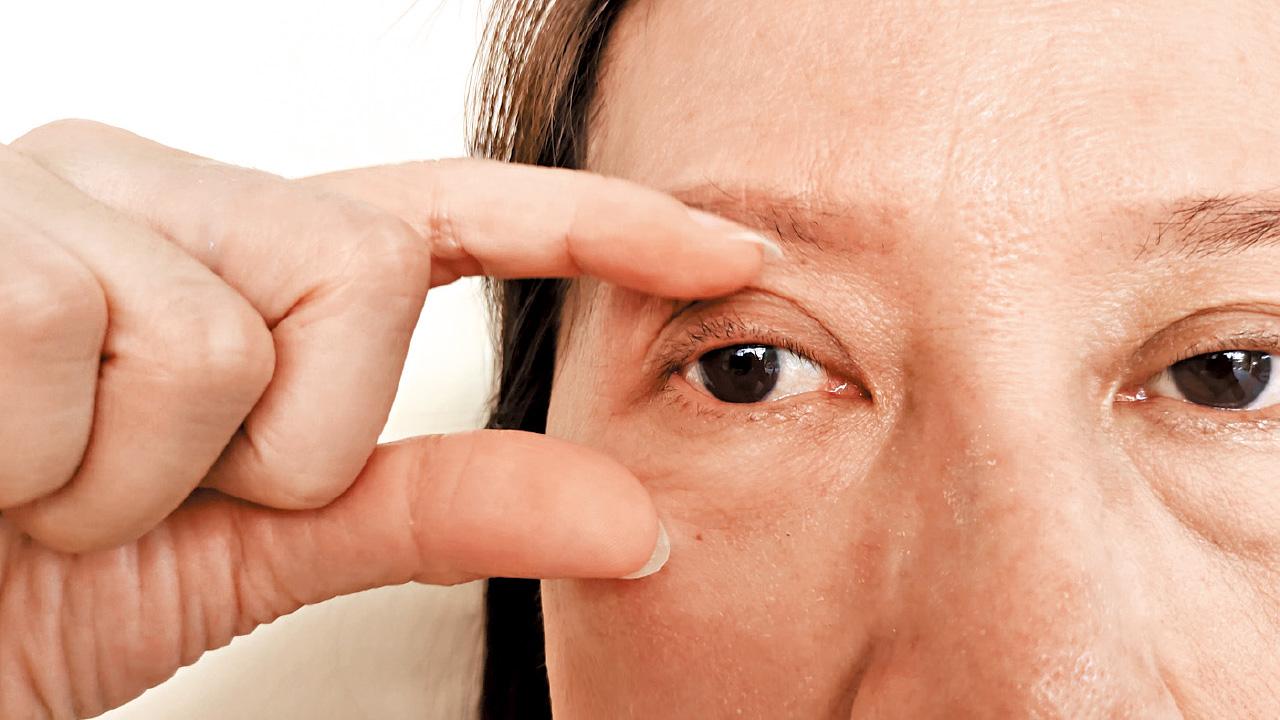 How Can Eye Bag Removal Help With Persistent Under-Eye Bags?