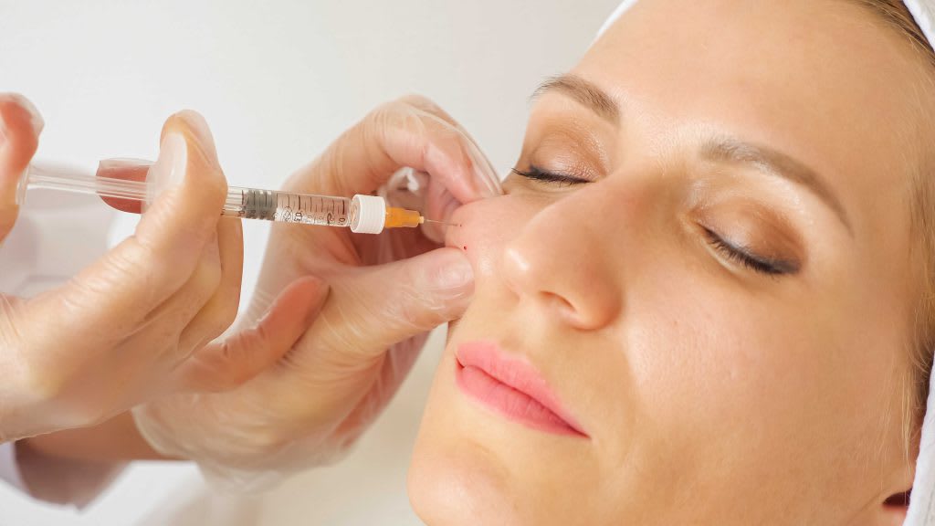 Is Restylane Filler Helpful for Supporting Marionette Lines?