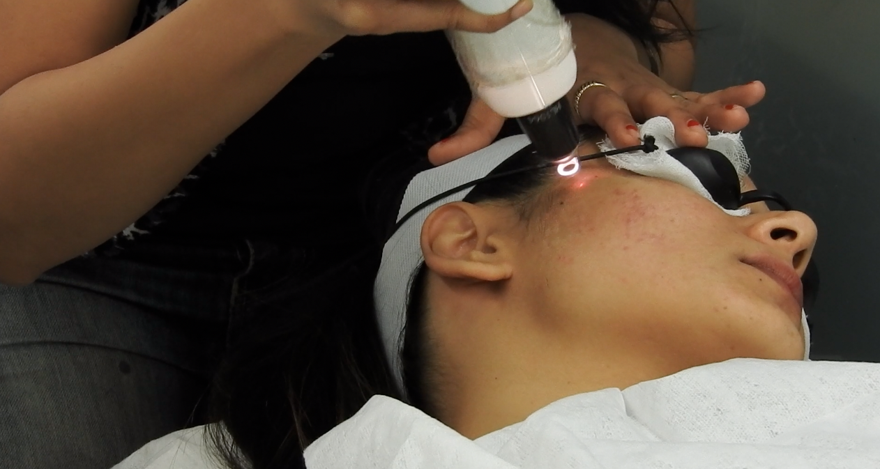 Is Laser Hair Bleaching Helpful for Managing Visible Hair?