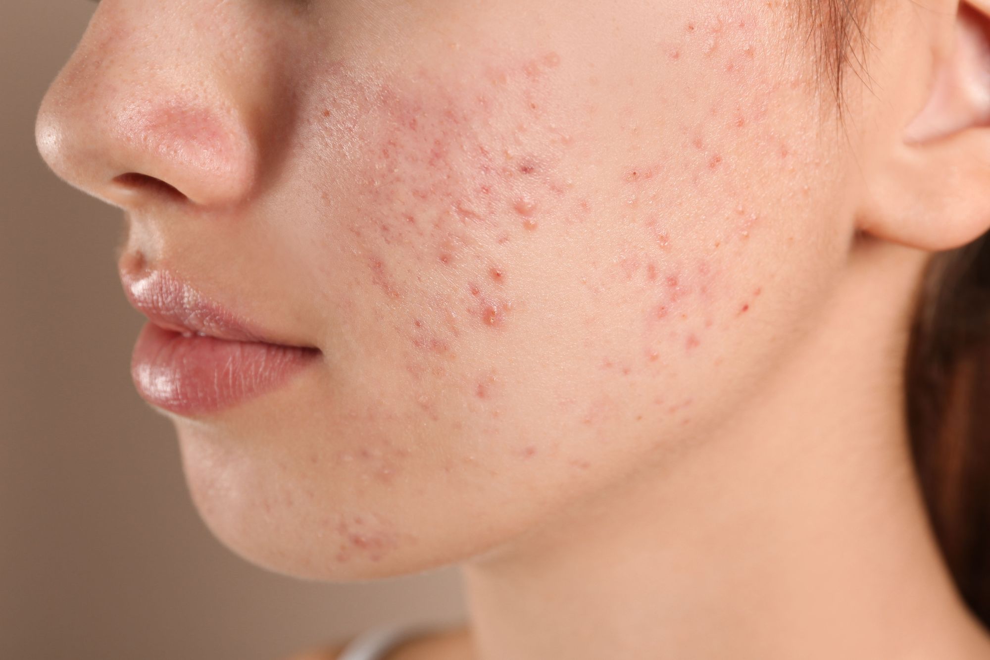 Is Pimples Treatment Helpful for Managing Stubborn Pimples?